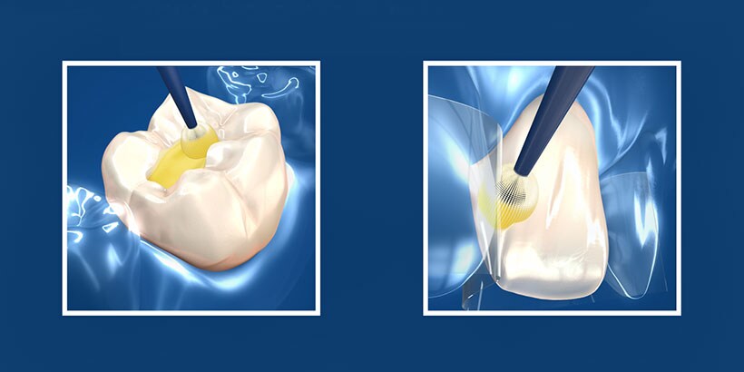 dental adhesive techniques
