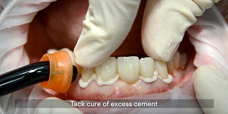 Chiếu đèn nhanh để lấy xi măng dư
