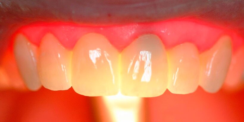 teeth full contour zirconia
