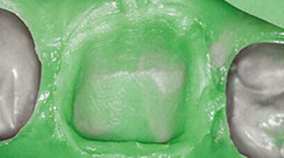 Dental impression mold showinig unclear margins
