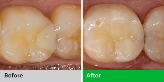 Ca lâm sàng về phục hồi thẩm mỹ răng sau bằng vật liệu composite
