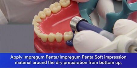 Kĩ thuật Monophase với 3M™ Impregum™ Penta™/3M™ Impregum Penta™ Soft
