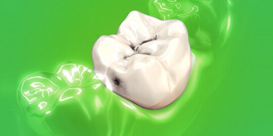 phục hồi composite xoang 2
