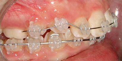 Mandibular Arch with ceramic braces
