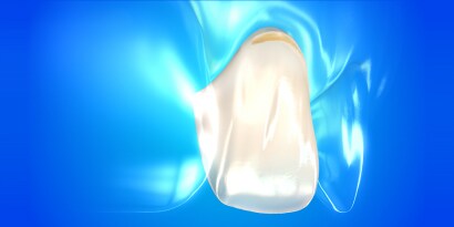 vật liệu trám composite dành cho phục hồi xoang 5
