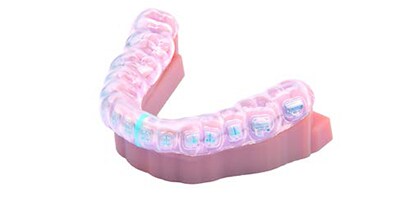 Bonding ceramic brackets to teeth
