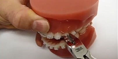 debonding clarity ceramic orthodontic brackets archwire
