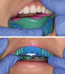 Maxillary arch Impression tray Placement