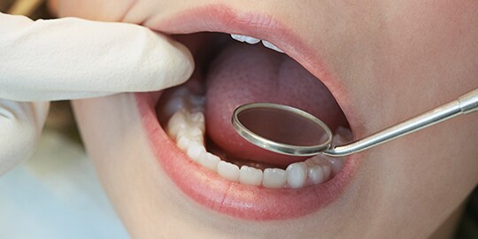 sản phẩm 3M cho phục hồi răng sau
