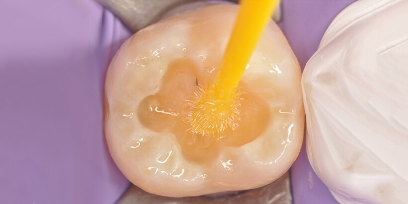 tooth filling
