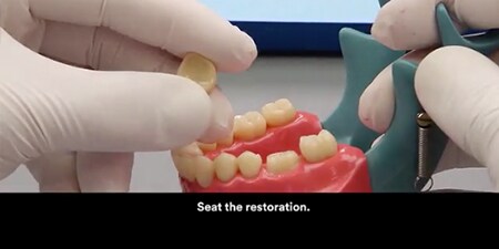 Gắn xi mão zirconia với xi măng 3M™ RelyX™ Unicem 2 Automix
