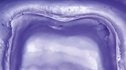 Dental impression showing voids on the margin
