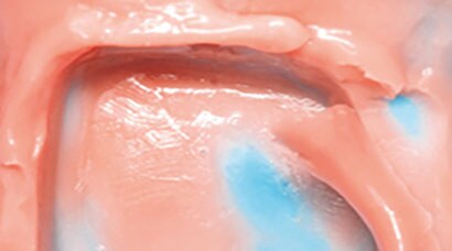 Torn margins in dental impression mold
