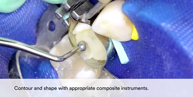 Tái tạo đường viền và hình thái răng với dụng cụ composite thích hợp.

