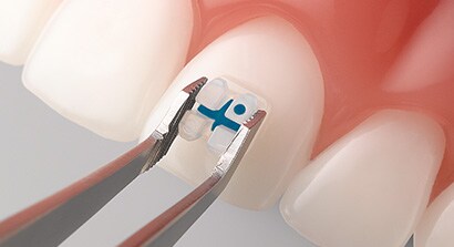 Định vị mắc cài
