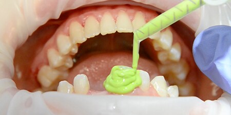 Quy trình Success Simplified: Cầu răng dán zirconia điều trị cho thiếu răng cửa bên bẩm sinh
