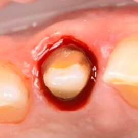 Using Retraction Capsule