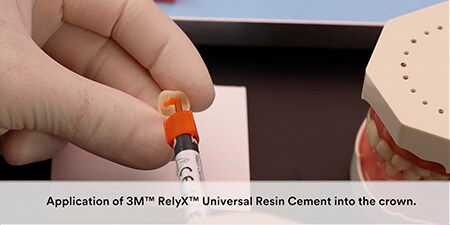 Cách gắn mão zirconia với xi măng 3M™ RelyX™ Universal Resin
